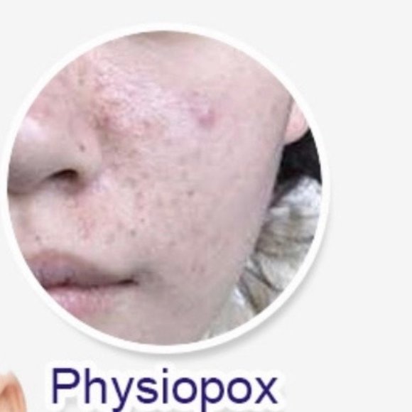 Anti acne whitening soap - Picture 4 of 7